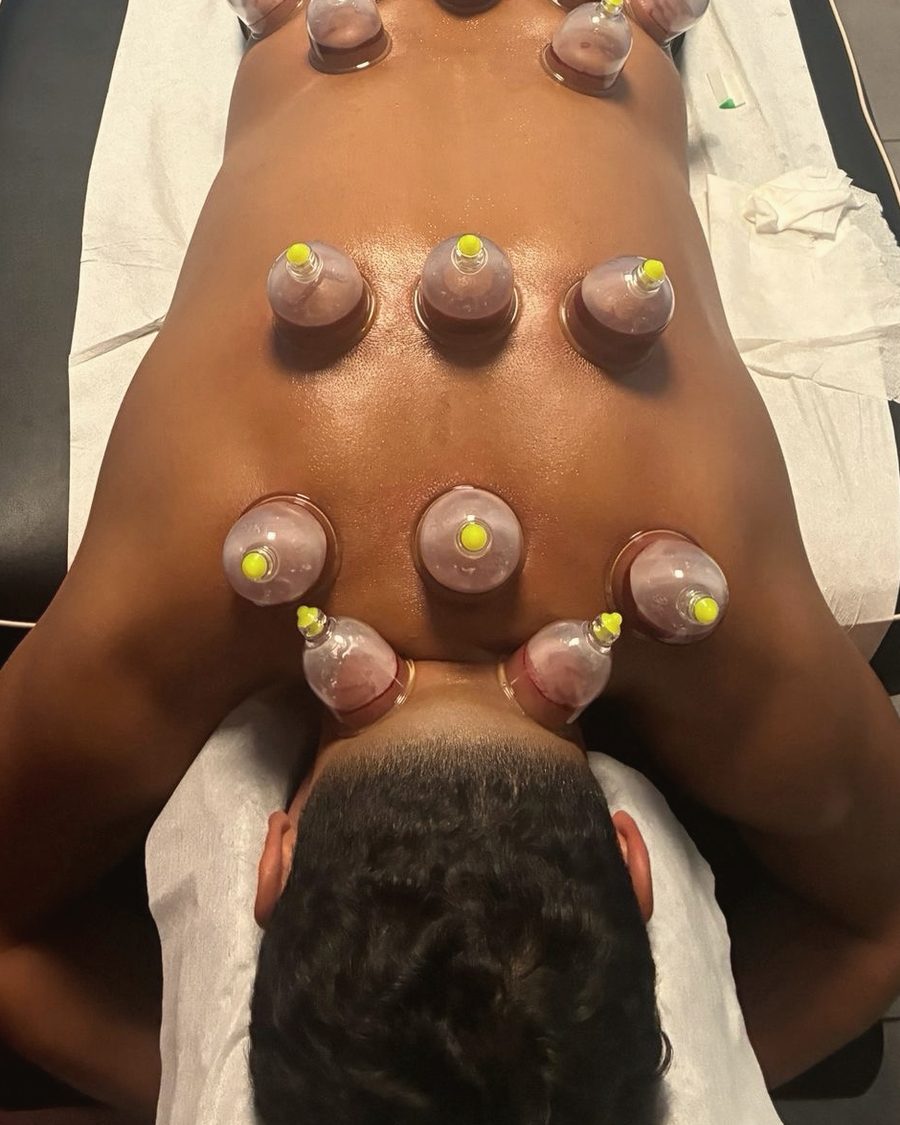 Kopper placeret på hele ryggen under en hijama-behandling