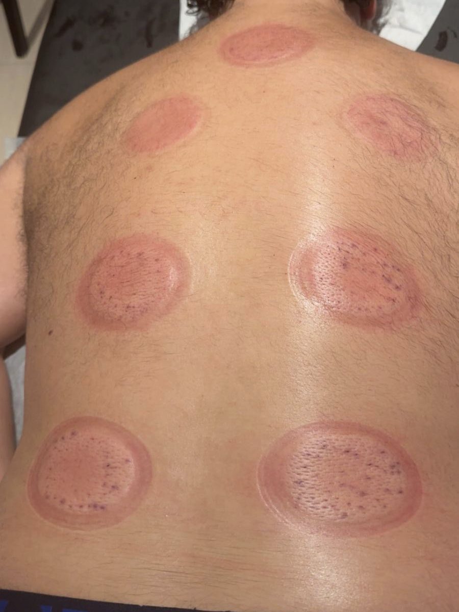 Mærker på ryggen dagen efter en cupping-behandling