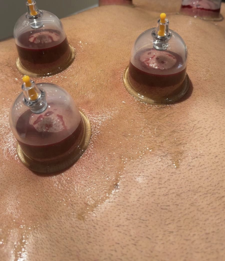 Kopper under en hijama-behandling